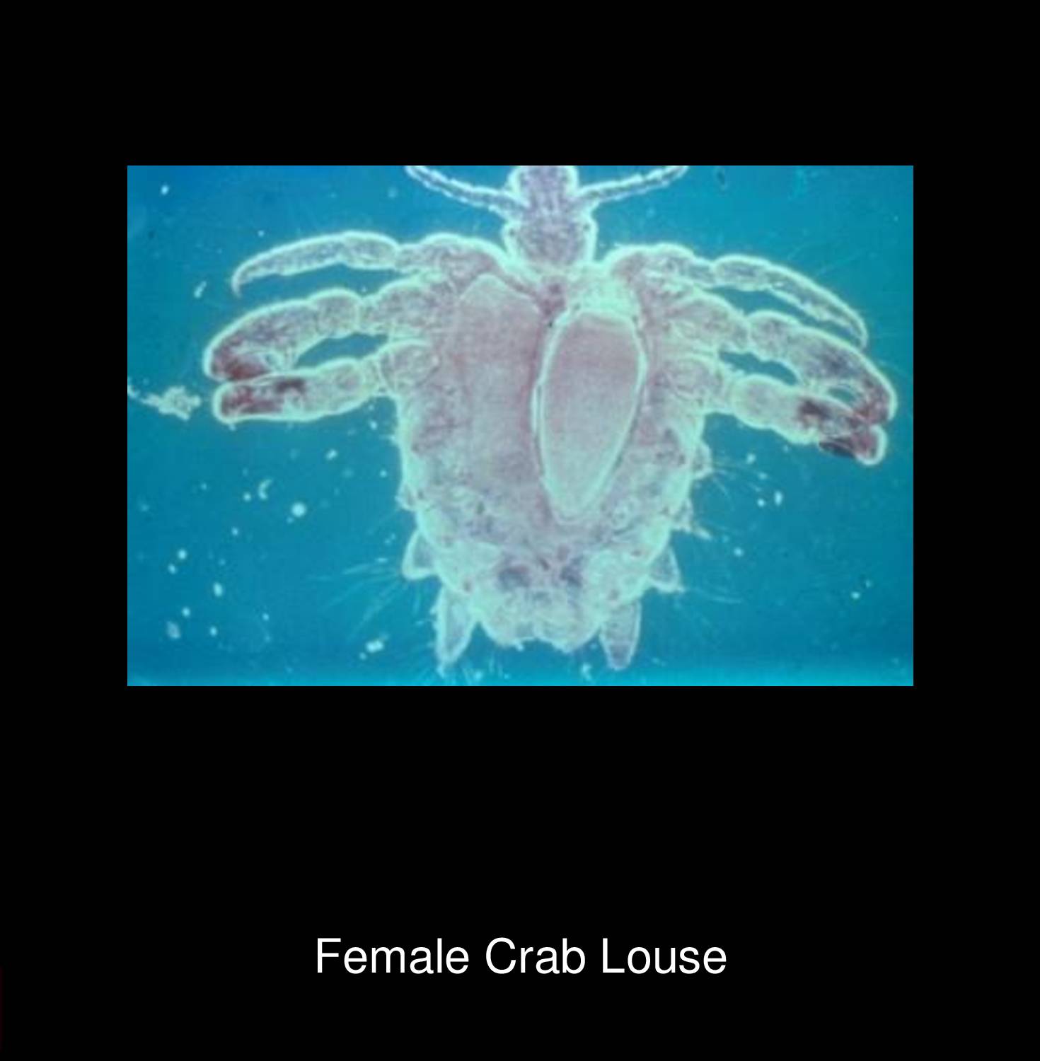 Pubic lice infestation showing adult Phthirus pubis crab louse attached to pubic hair with visible nits eggs on hair shafts diagnosed at STD Nepal